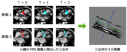 画像認識 MRI画像 三尖弁 動きを可視化 画像検出の応用例